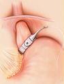 Gastric Band