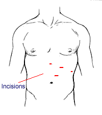 Laparoscopic