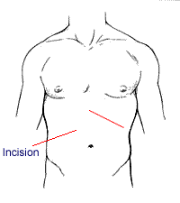 Incicsion