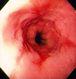 oesophagitis