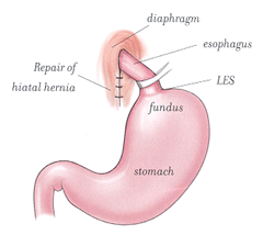 hiatal repair