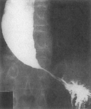 achalasia