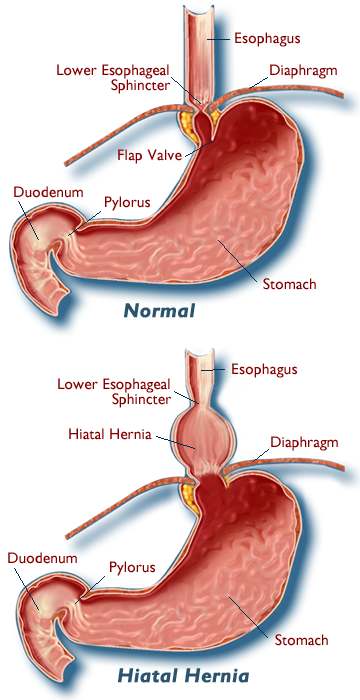 Hiatal Hernia